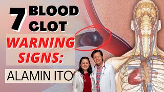 7 Blood Clot Warning Signs Alamin Ito  By Doc Willie Ong Internist and Cardiologist [upl. by Arabeila]