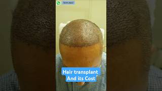 Hair transplant and its cost hair hairtransplant shorts [upl. by Ecnar88]