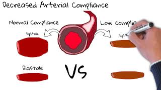 Isolated systolic hypertension  Most common hypertension among elderly [upl. by Narok60]