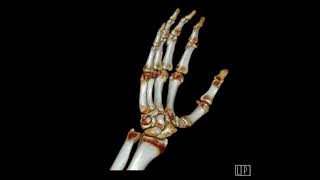 3rd metatarsal neck fracture [upl. by Rodama]