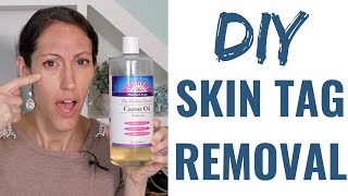 How to Get Rid of a Skin Tag  Natural Skin Tag Removal Home Remedies amp Tips [upl. by Gardia]