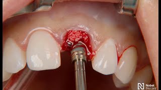 Restoration of a central incisor  Clinical case with On1 Base Xeal and NobelActive TiUltra [upl. by Carmela]