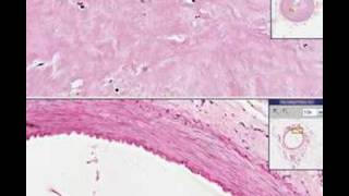 Histopathology Coronary arteryAtherosclerosis recanalizat [upl. by Pascha]