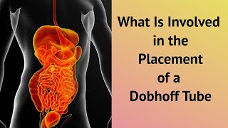 What Is Involved in the Placement of a Dobhoff Tube [upl. by Eeltrebor]