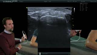 Elleboog  Common extensor tendon dwars  E14  echografie [upl. by Kathe]