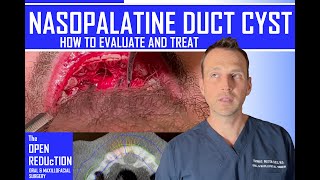 NASOPALATINE DUCT CYST REMOVAL [upl. by Asamot418]