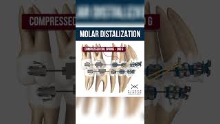 MOLAR DISTALIZATION  ORTHODONTIC TIPS Shorts [upl. by Ellirehs]