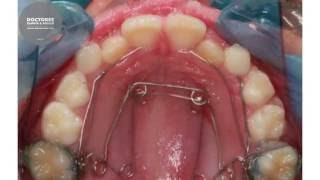 Morphing  Orthodontic maxillary expansion with Quad Helix [upl. by Esme625]