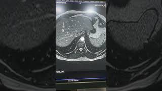 MRCP AXIAL SECTION t2trufitrap2bh Sequence mrcp [upl. by Gnoc530]