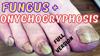 Thick fungal toenails treatment  rams horn onychogryphosis [upl. by Sternberg]