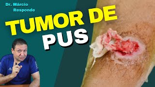 ABSCESSO tumor de pus pode dar febre após drenagem  Dr Márcio Responde [upl. by Ailahs]