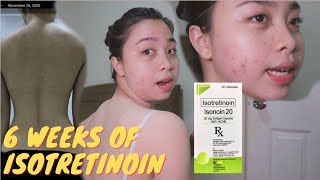 KAMUSTA ANG BACNE KO back acne  6th WEEK ISOTRETINOIN UPDATE [upl. by Asnarepse]