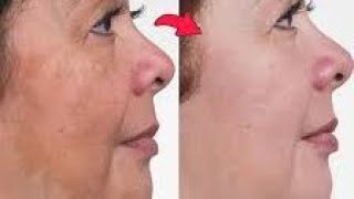 pigmentation remove Dermaquin cream uses And side Effects Dermaquin 2 skin Bleaching cream review [upl. by Erimahs]