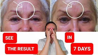 Get rid of FROWN LINES  Reduce FOREHEAD WRINKLES [upl. by Dnamron]