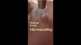 Medical Grade Microneedling [upl. by Akeim]