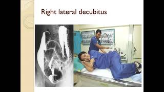 Barium Enema procedure and patterns [upl. by Allicserp]