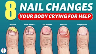 Nail signs of Disease  Nail pitting  Finger clubbing  Signs of anemia  Terrys nails [upl. by Kecaj]