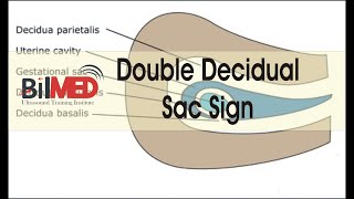 DOUBLE DECIDUAL SAC SIGN  Vlogs  BilMed USG Training [upl. by Nibur519]