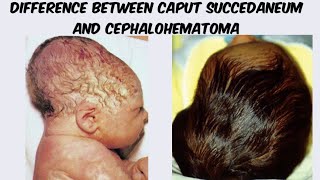 Difference between caput succedaneun and cephalohematoma [upl. by Fredel]