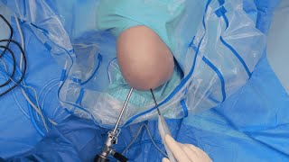 ApolloRF® SJ50 Probe for Meniscal and Chondroplasty Procedures [upl. by Eiramllij]