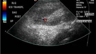 Renal arteriovenous malformation [upl. by Ennaer]