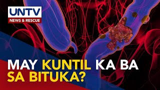 Pagkakaroon ng kuntil o polyps sa bituka posibleng mauwi sa colon cancer – expert [upl. by Celeski994]