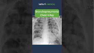 Understanding Bronchopneumonia 🫁 MedicalEducation usmle [upl. by Celestyna]