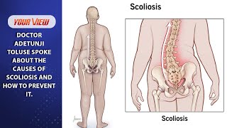 Lets Talk Segment Causes And Prevention Of Scoliosis [upl. by Adena402]