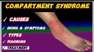 compartment syndrome [upl. by Lac862]