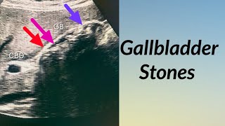 Gallbladder Ultrasound  Gallbladder with Multiple Stones  Ultrasound of the Abdomen [upl. by Issi]