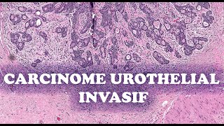 LE CARCINOME UROTHELIAL INVASIF SousTypes – PATHOLOGIE [upl. by Aserahs]