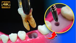 FASINANTE proceso del IMPLANTE dental en 4K [upl. by Russom679]