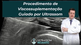 Procedimento de Viscossuplementação Guiado por Ultrassonografia em Osteoartrite de Joelho [upl. by Eveineg]