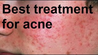 Best treatment for acne [upl. by Ppilihp675]