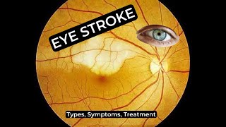 Eye Stroke Types Symptoms and Treatment Retinal Vein Occlusion [upl. by Hudnut]