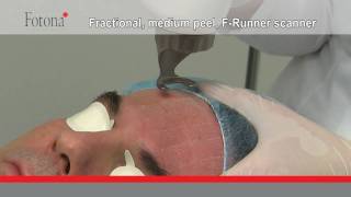 Medium peel with Fotonas fractional ErYAG scanner FRunner [upl. by Nahtam]