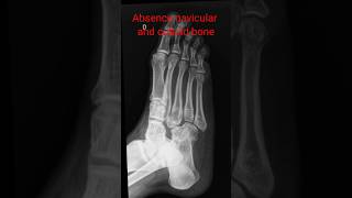 Absence of tarsal bones navicular and cuboid bone shorts footxray [upl. by Euqinommod]