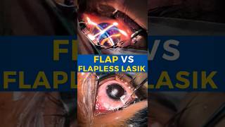 Flap VS Flapless Lasik [upl. by Poliard705]