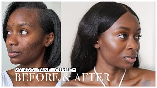 How I Cleared My Acne After 18 Years  Accutane Journey Side Effects Before amp After [upl. by Aiekram]