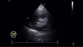 Aortic Stenosis  Transtoracic Echocardiography  Estenose aórtica  Ecocardiografia Transtorácica [upl. by Ahsataj]