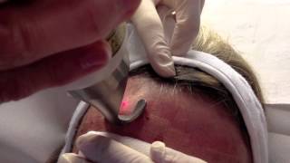 Resurfacing dermabrasion du visage au laser Erbium [upl. by Allin603]