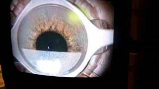 Step by Step Intralasik procedure for Monovision right eye of patient Sandy [upl. by Kcinnay]