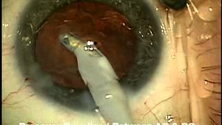 how to fix reverse pupillary block during cataract surgery  Uday Devgan MD Los Angeles [upl. by Rogerio762]