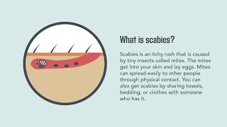 Scabies Signs Symptoms Causes and Treatment  Merck Manual Consumer Version [upl. by Otrevogir]