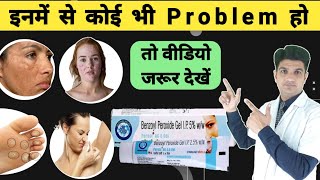 Acne की लाजवाब दवा  Benzoyl peroxide gel 25  Benzoyl peroxide for acne [upl. by Maloney111]