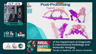 Post processing techniques in the preoperative management of conjoined twins [upl. by Treharne]