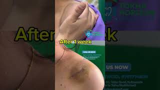 Lipoma removal surgery  results  dr bijay  tokha horizon [upl. by Mar]