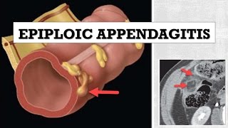 Epiploic Appendagitis [upl. by Faber]