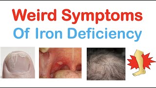 Weird Symptoms of Iron Deficiency  Nails Tongue Skin Hair amp Others [upl. by Wong]