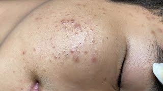 ACNE TREATMENT VU QUYNH MI  Blackheads On Boy Face 2024FULL [upl. by Tillo]